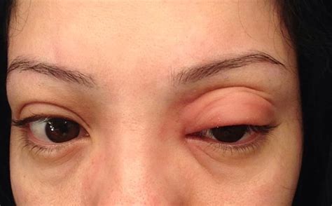 Swollen Red Itchy Eyes Allergy Reaction To Methylisothiazolinone A