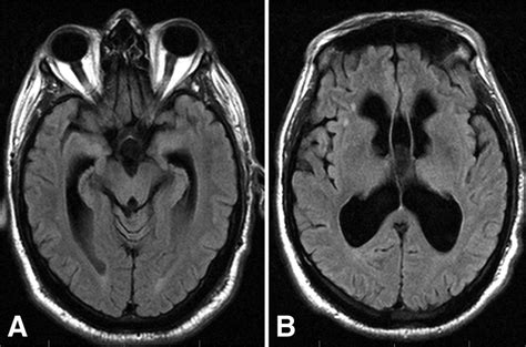 Flair Axial Images Of The Brain In A Patient With Diagnosed Nph The