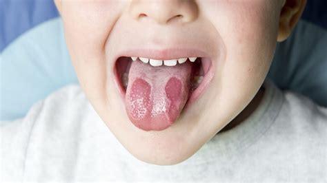 Natural Cures And Home Remedies For Burning Tongue Syndrome