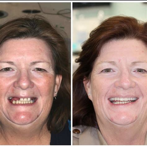 dental implants treatment sparkle dental joondalup