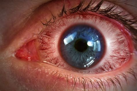 Drug Treats Retinal Diseases With Drops Instead Of Injections Wales