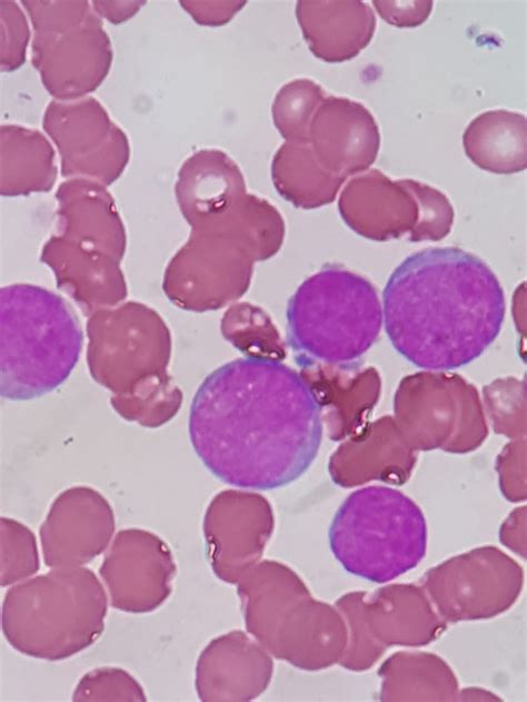 Symptoms may include bleeding and bruising, fatigue, fever, and an increased risk of infections. Leucemia Mieloide Aguda M2 Caso Clinico - Hemoclass ...