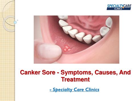 Ppt Canker Sore Symptoms Causes And Treatment Powerpoint Presentation Id 11123845