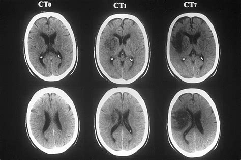 Delayed Increase In Infarct Volume After Cerebral Ischemia Stroke