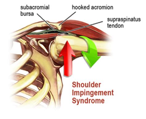 Shoulder Impingement Physio Professionals 3 Locations On The Sunshine