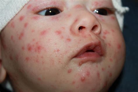 Common Skin Problems In Children Starmommy