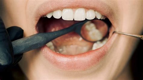 The Ins and Outs of Oral Piercings: Navigating Risks and Aftercare