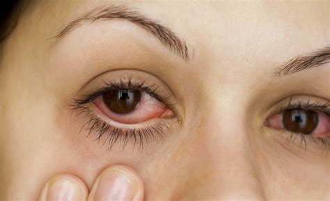 Instituto Provis O Alergia Ocular Principal Causa De Coceira Nos Olhos