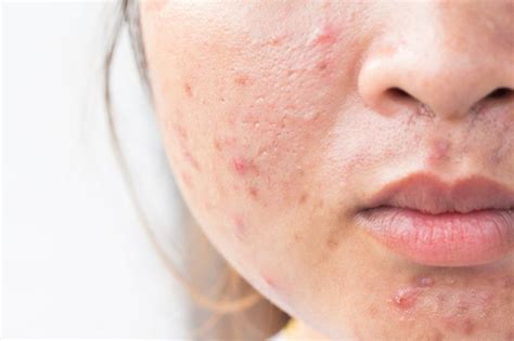 Why Dry Skin Can Cause Acne And Ways To Improve It Jil Goorman Beauty
