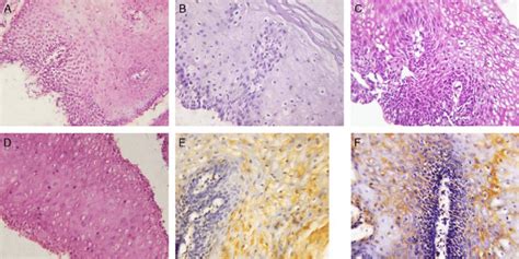 Histopathologic Findings In Esophageal Mucosa Of Gastroesophageal