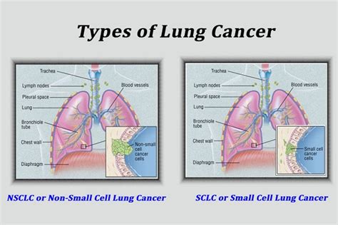 How To Detect Lung Cancer Before Its Too Late