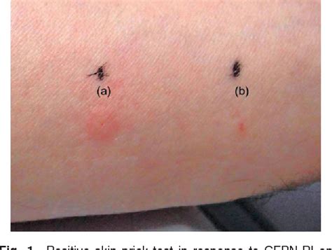 Figure 1 From Positive Skin Prick Test To Cefcapene Pivoxil