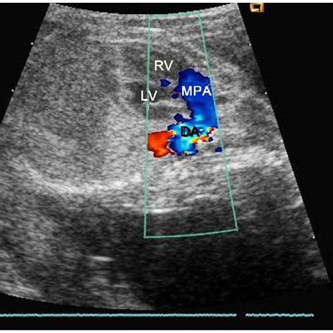 D Color Doppler Fetal Echocardiographic Image Showing Turbulence In