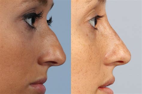 Nose Shaping With Surgery Or Nose Filler Dr Brett Kotlus Cosmetic Free Download Nude Photo Gallery