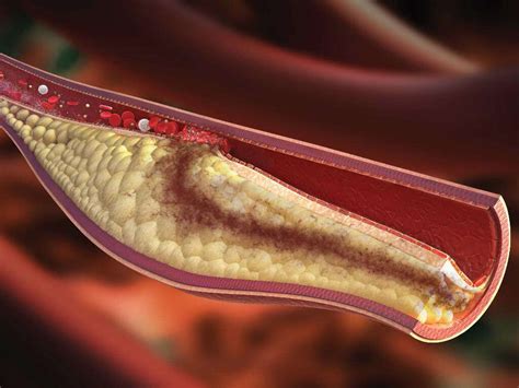 Hyperlipidemia Hyperlipidemia Symptoms