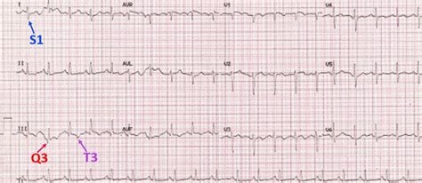 S1q3t3 Pattern On Ecg In Pulmonary Embolism