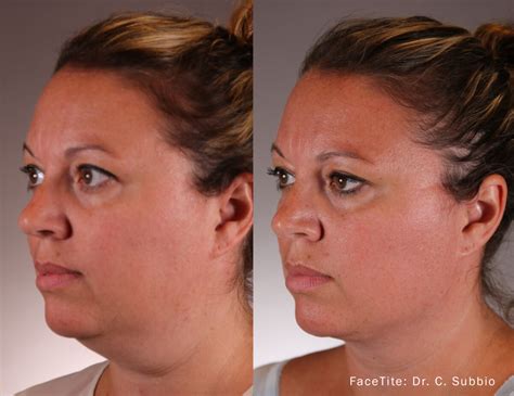 Facetite By Inmode — Minimally Invasive Facial Contouring Bahman