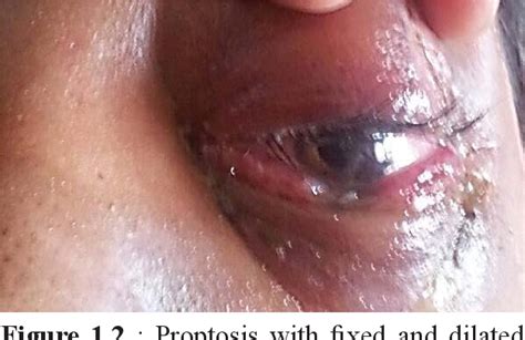 Figure 11 From Traumatic Orbital Compartment Syndrome A Sight