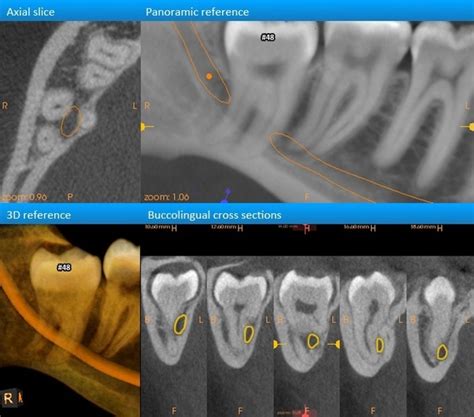 Should I Get My Impacted Wisdom Tooth Removed It Causes Bad Pain Every