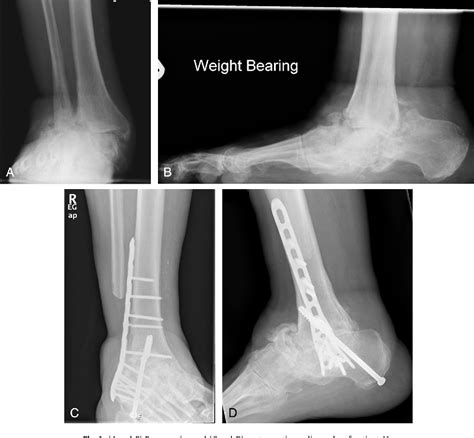 Use Of A Proximal Humeral Locking Plate For Complex Ankle And Hindfoot