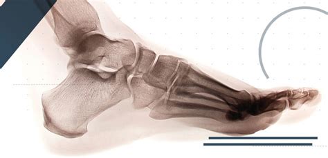Lisfranc Injuries In Sport An Overview On How To Cure Them