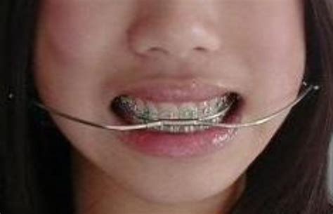Maybe you would like to learn more about one of these? How to Get Rid & Fix an Overbite - Healthrow.net