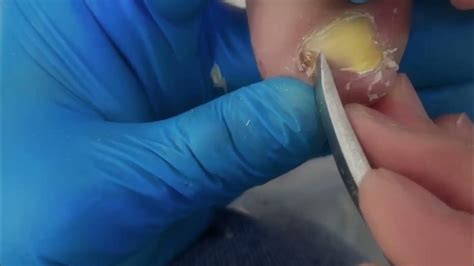 Pedicure Tutorial：the Large Embedded Toenails Are Removed Please Trim The Toenails In Time