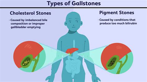Gallstones Causes Symptoms And Treatment Helal Medical