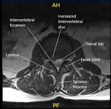 Case Study Prolapsed Lumbar Intervertebral Disc Management