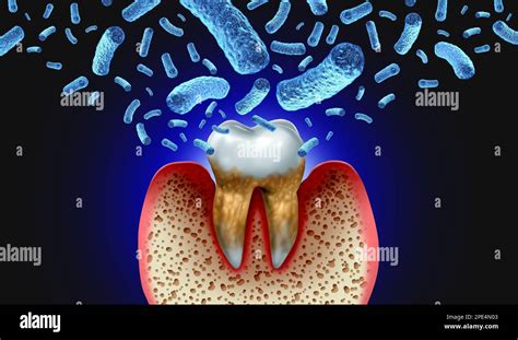 Bacterial Tooth Infection And Teeth Decay Disease As An Unhealthy Molar