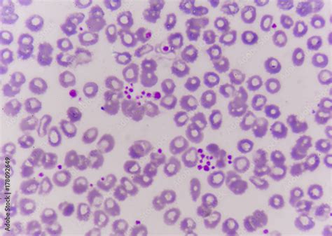 Platelet Clumping As A Possible Cause Of Low Platelet Count In Patients