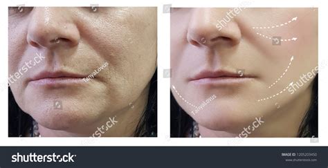 Woman Wrinkles Before After Procedures Stock Photo 1205203450