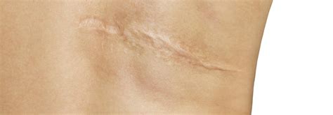 Scar Removal Treatment Vitalskin Dermatology