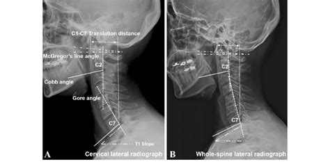 Measurements Of Cervical Parameters On A Cervical Lateral Radiograph