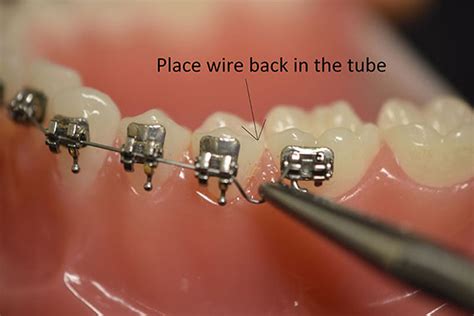How To Cut Braces Wire At Home Covid 19 Orthodontic Emergency And