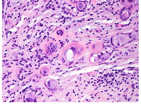 High Power Magnification Of Dcis Involving Sclerosing Adenosis With