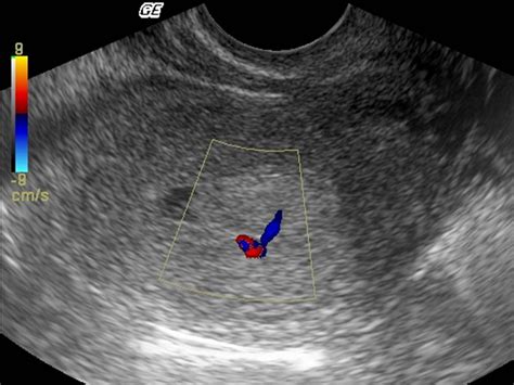 Usefulness Of Endovaginal Ultrasound In The Diagnosis Of A