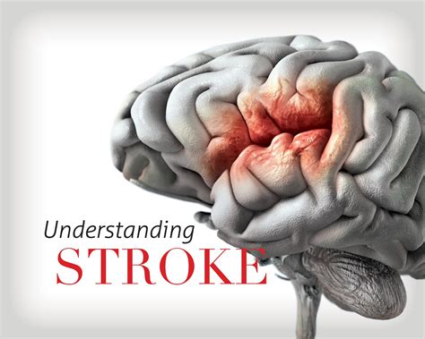 Traumagency Brainstem Stroke Syndromes