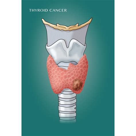 Thyroid Cancer And Larynx Poster Print By Monica Schroederscience Source