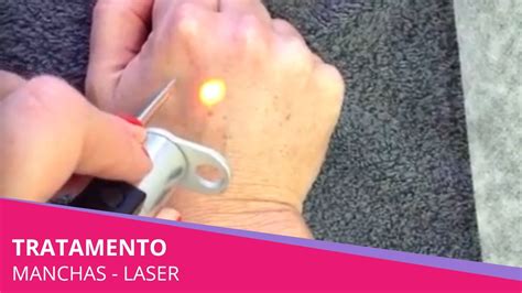 Tratamento De Manchas A Laser YouTube