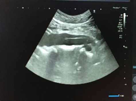 Vietnamese Medic Ultrasound Case 545 Aortic Dissection Dr Phan Thanh