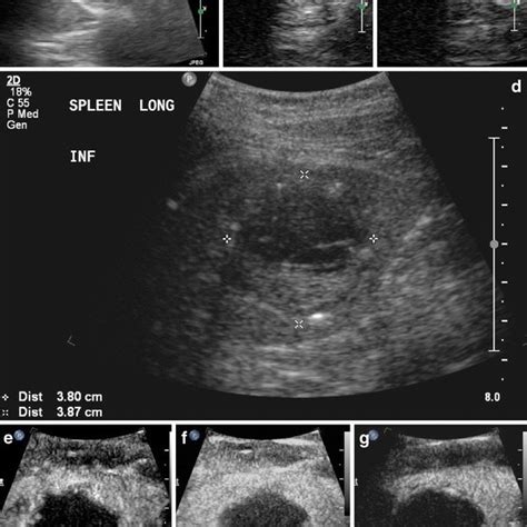 1 Innumerable Hypoechoic Granulomas A In A Mildly Enlarged Spleen In