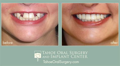 An implant retained partial denture replaces the back teeth in the lower jaw and eliminates the need for metal clasps. Before/After Photo Gallery | Tahoe Oral Surgery