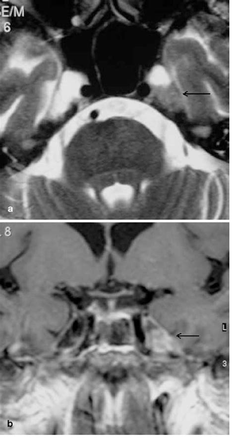 A T2 Weighted Axial And B Post Gadolinium T1 Weighted Axial Mr Images