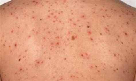 Early Symptomatic Hiv Infection As Related To Hives Pictures