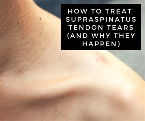 A Guide To Supraspinatus Tendon Tears Rotator Cuff Injury Youmemindbody