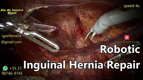 Inguinal Hernia Robotic Tapp Repair All Landmarks Fullhd 032017