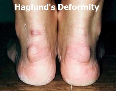 Discover More Than Heel Pain Haglund S Deformity Best Esthdonghoadian