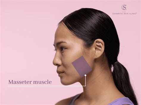Masseter Botox How To Treat Teeth Grinding With Botox And Reduce A Widening Lower Face The