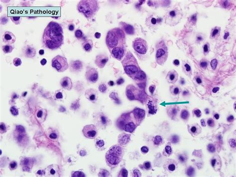 Qiaos Pathology Malignant Ascites With Metastatic Pancre Flickr